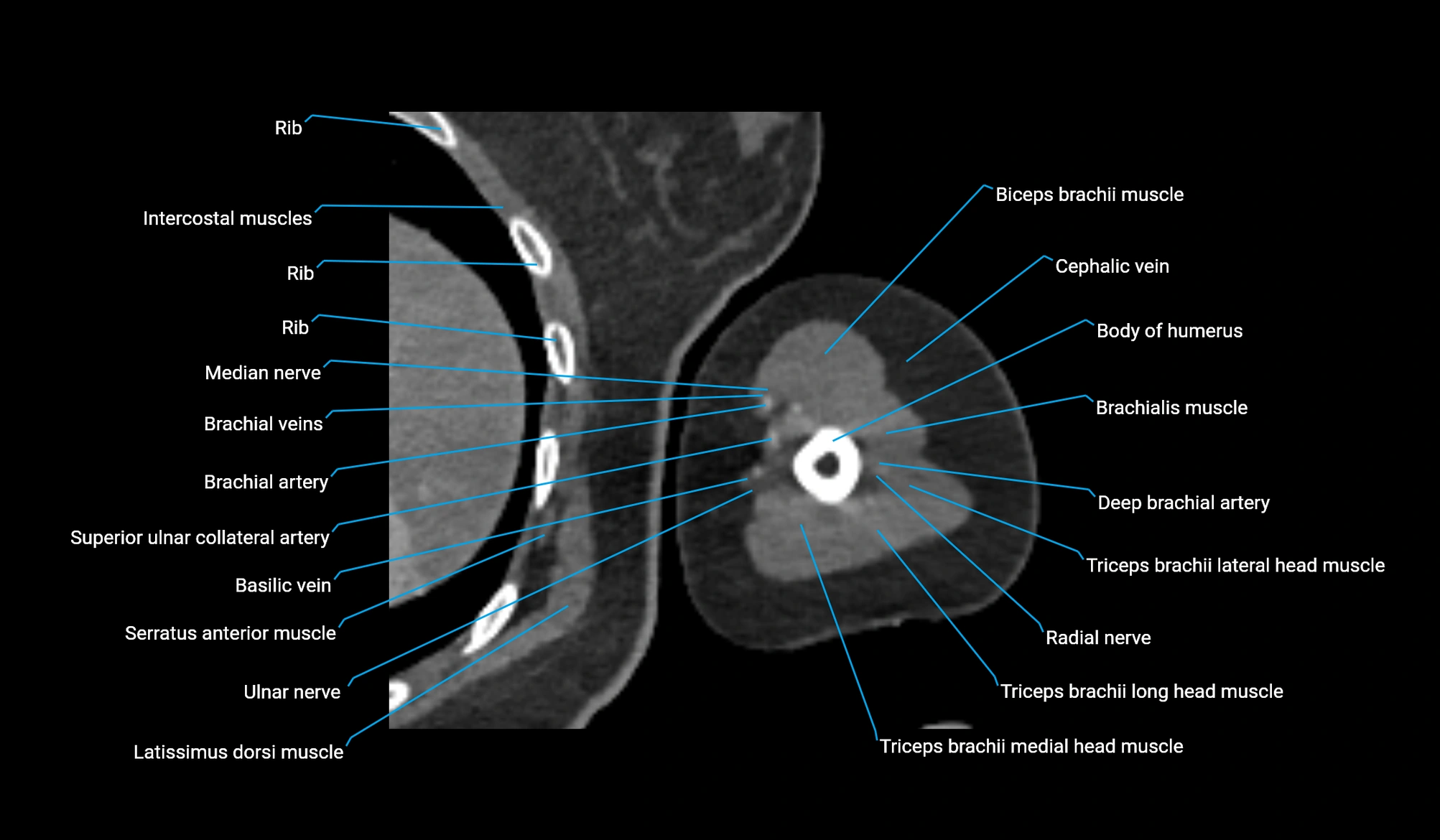 CT upper arm axial  cross sectional anatomy labelled radiology image -00268.webp